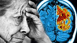 Alzheimer Hastalığı Nedir? Belirtileri ve Bakım Rehberi
